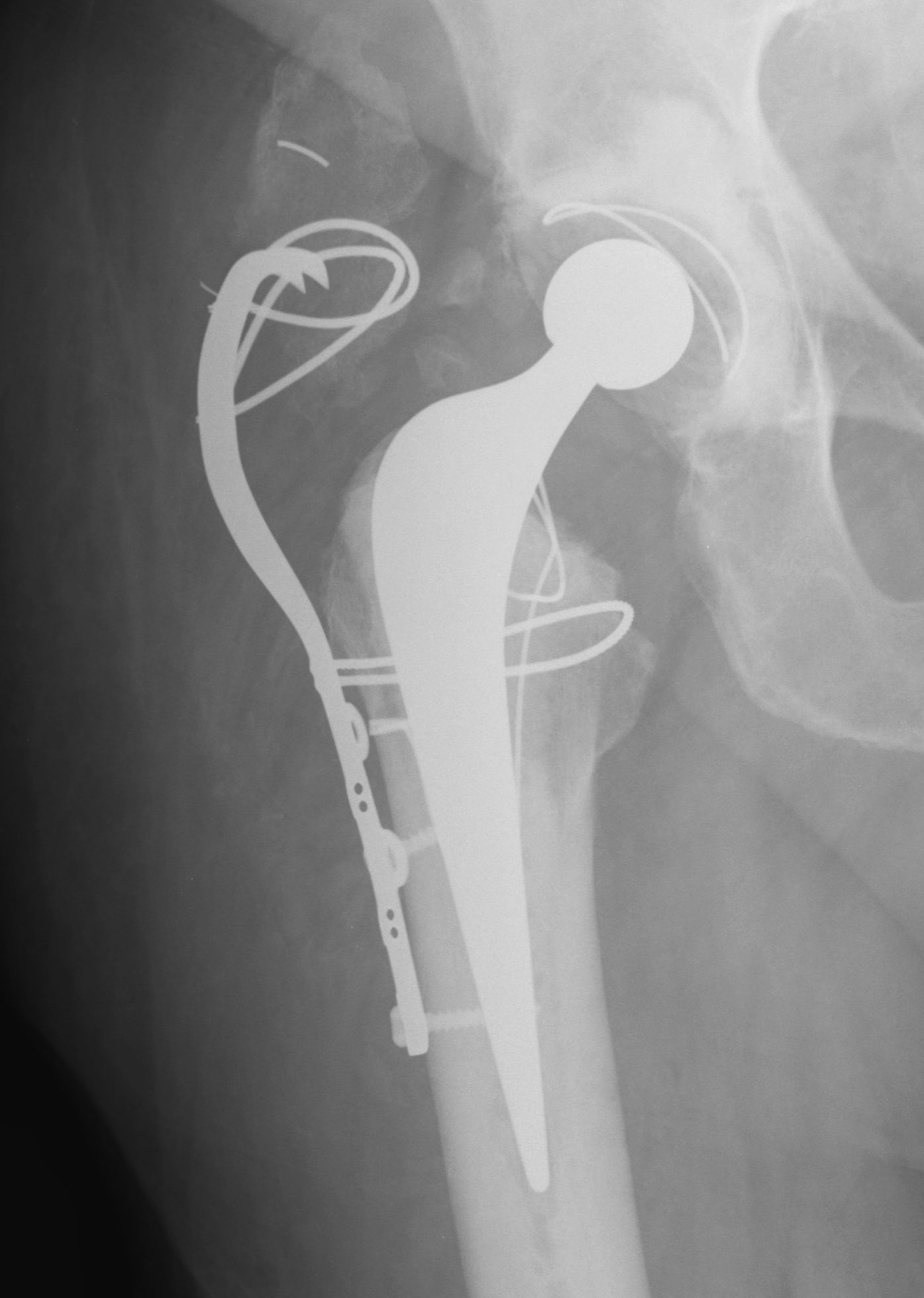 GT Osteotomy Failed Plate